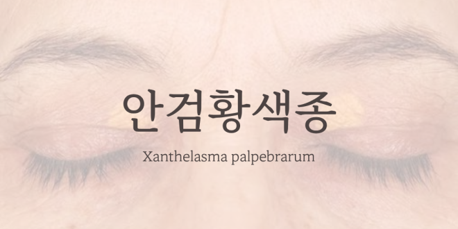 안검황색종 Xanthelasma palpebrarum