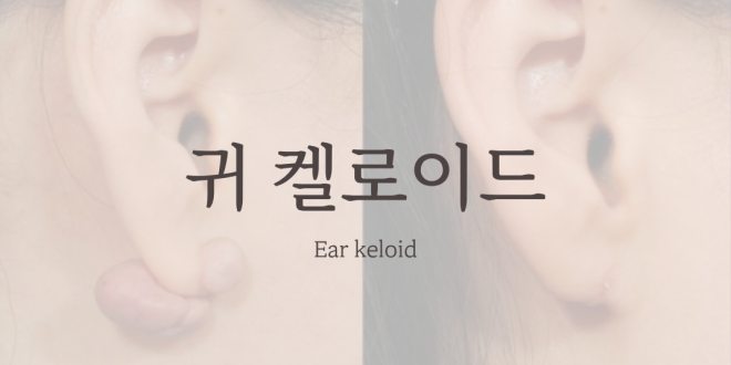 귀 켈로이드 Ear Keloid