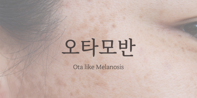 오타모반 Ota like Melanosis