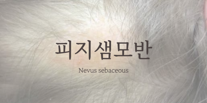 피지샘모반 Nevus sebaceous